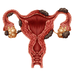 Endometriosis on female reproductive organs