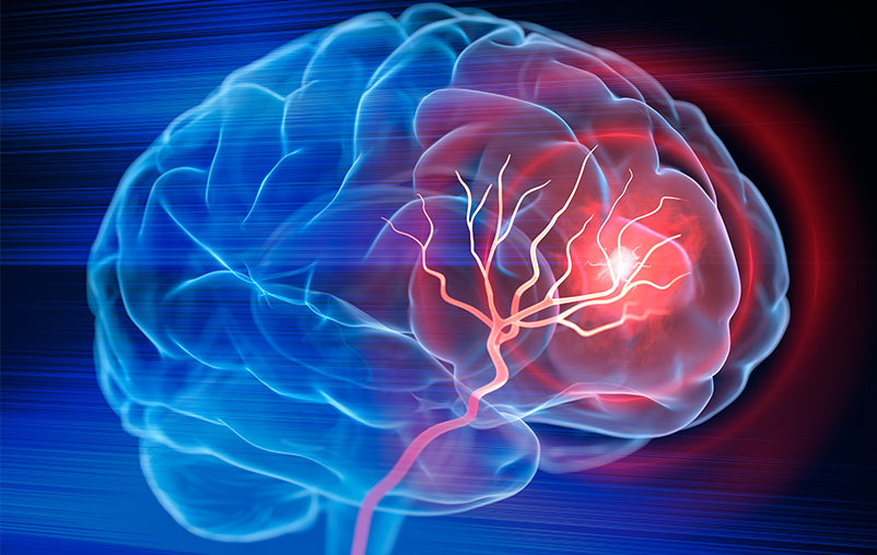 Animated image of a brain with a red area, indicating a stroke