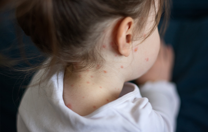A young girl has red spots on her skin, indicating measles.