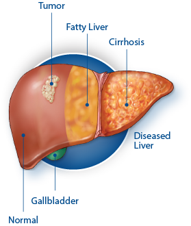 An illustration of a liver, showing a tumor, fatty liver, cirrhosis, diseased liver, normal liver and gallbladder.