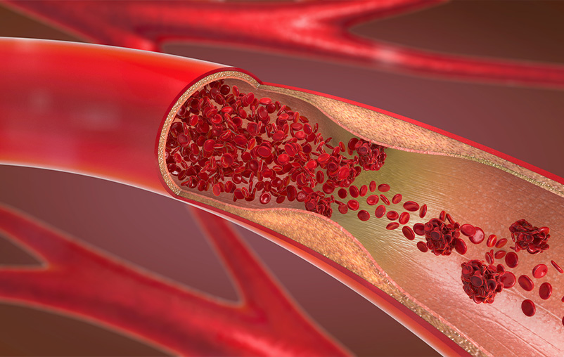 Illustration of blood cells flowing through an artery with some plaque buildup.